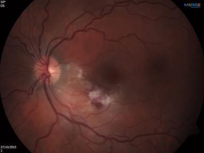 Case Report: Cytomegalovirus-specific T-lymphocyte infusion for resistant cytomegalovirus retinitis